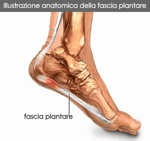 fascite-plantare